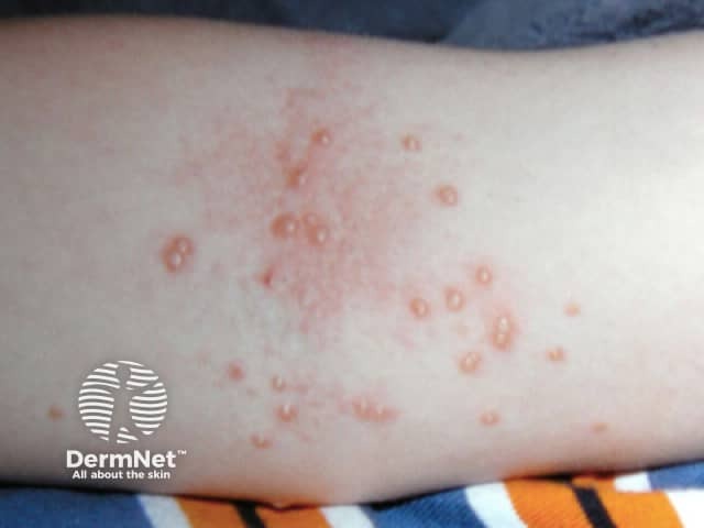 Molluscum contagiosum