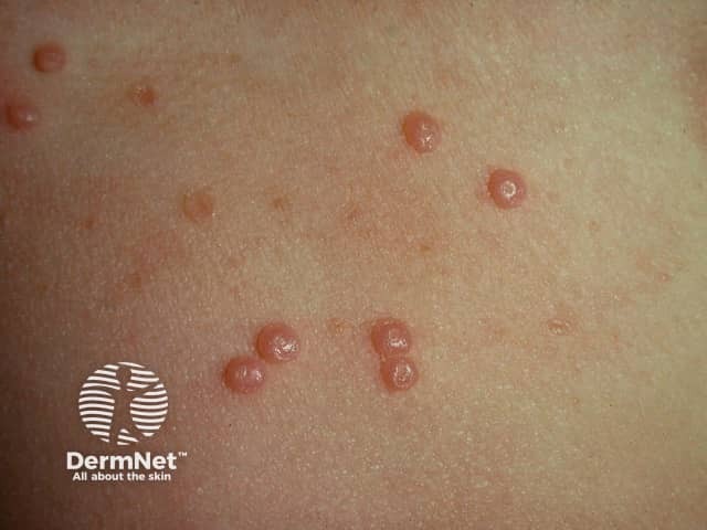 Molluscum contagiosum