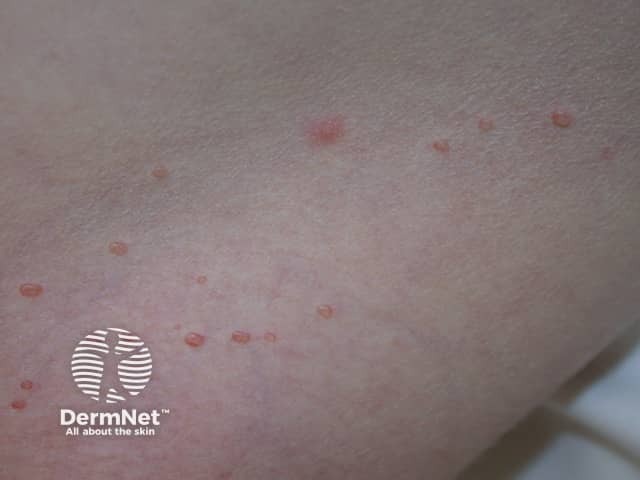 Molluscum contagiosum