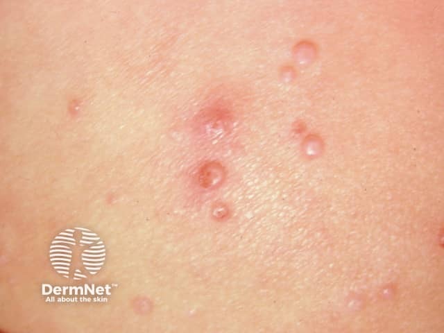 Molluscum contagiosum