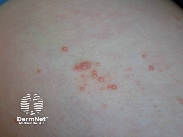 Molluscum contagiosum