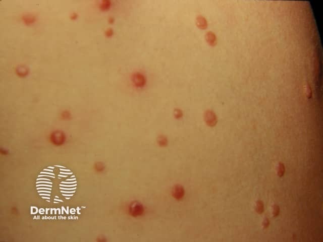 Molluscum contagiosum