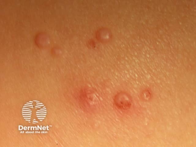 Molluscum contagiosum