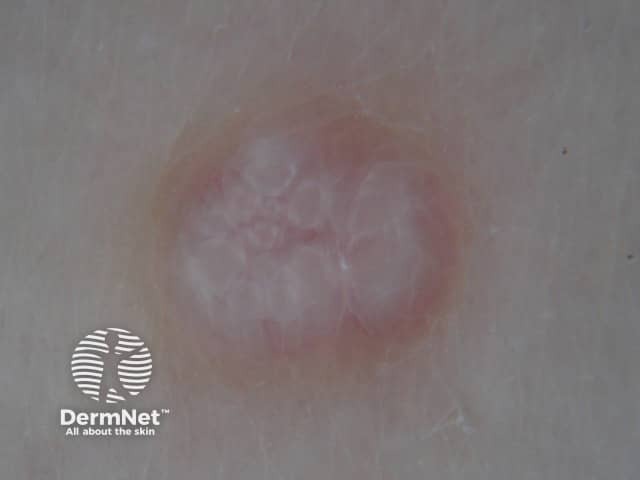 Molluscum contagiosum