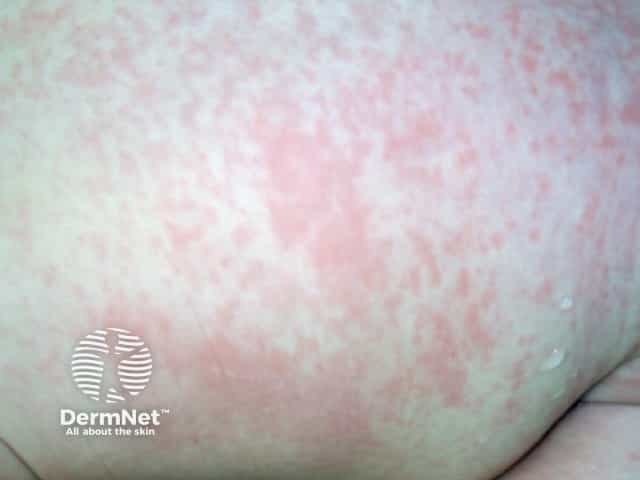 Rubella rash