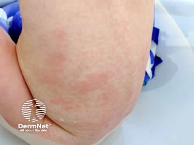 Rubella rash