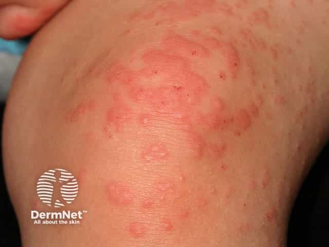 Papular acrodermatitis of childhood