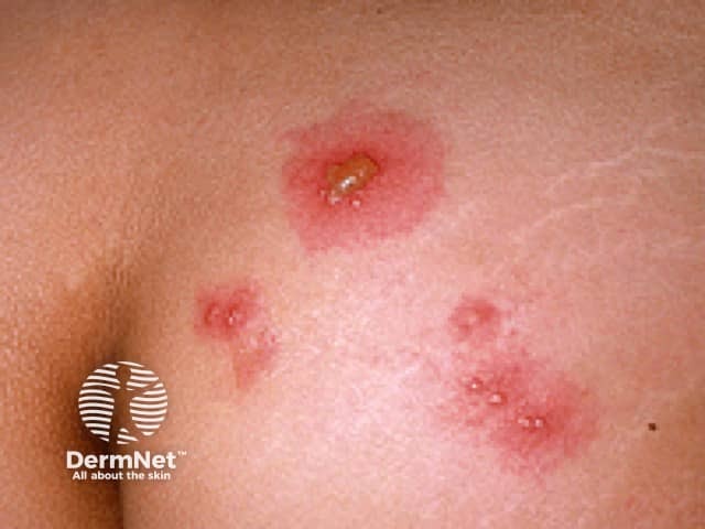 Herpes simplex