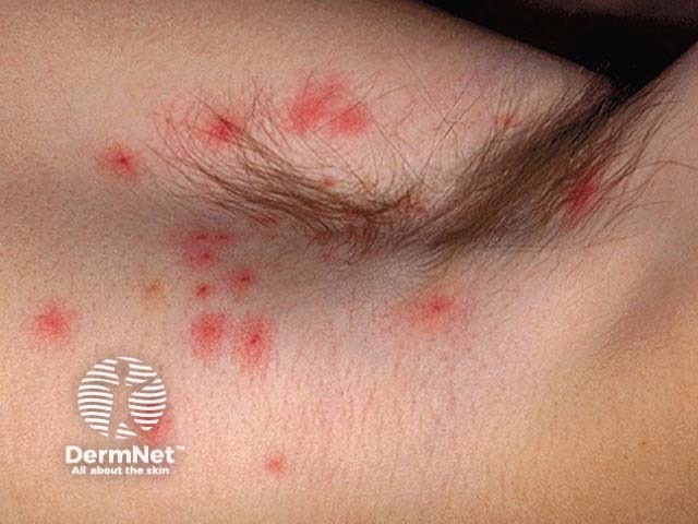 Molluscum contagiosum