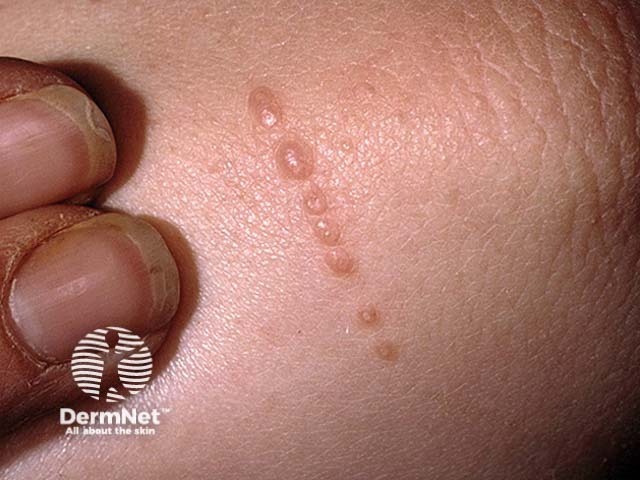 Molluscum contagiosum