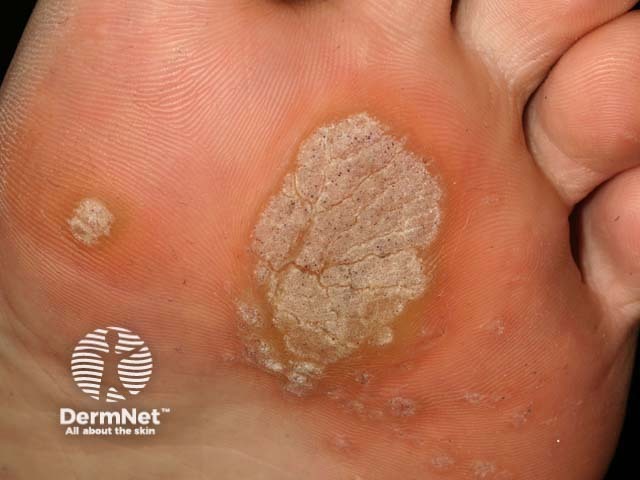 Plantar warts