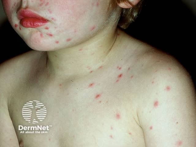 Chickenpox