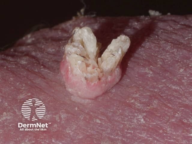 Filliform wart