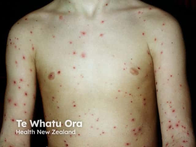 Chickenpox