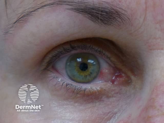 Conjunctivitis