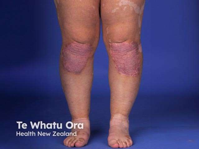 Vitiligo + psoriasis