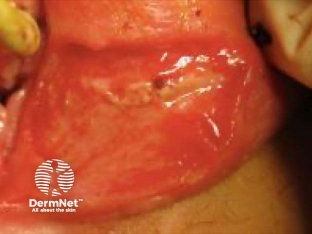 Vulval ulcer