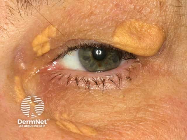 Xanthelasma