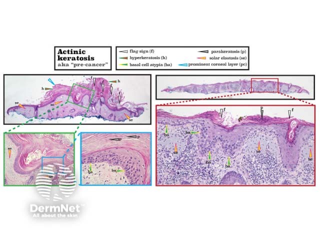 Histopathology of actinic keratosis