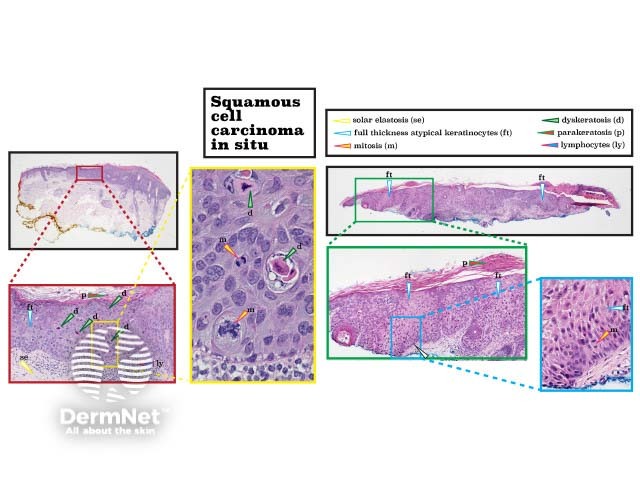 Histopathology of squamous cell carcinoma in situ