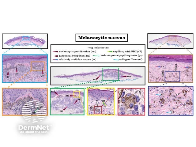 Histopathology of melanocytic naevus