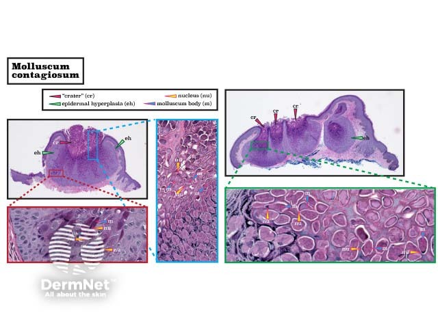 Histopathology of molluscum