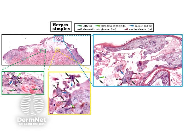 Histopathology of herpes simplex