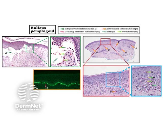 Histopathology of bullous pemphigoid