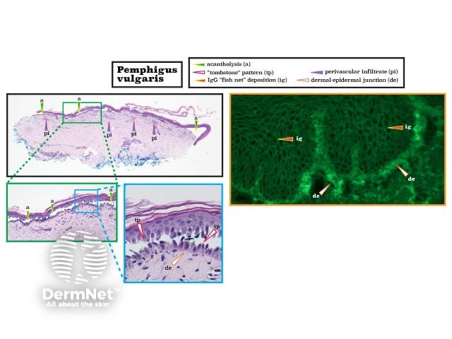 Histopathology of pemphigus vulgaris