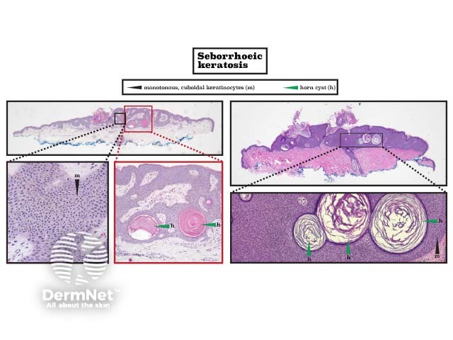 Histopathology of seborrhoeic keratosis