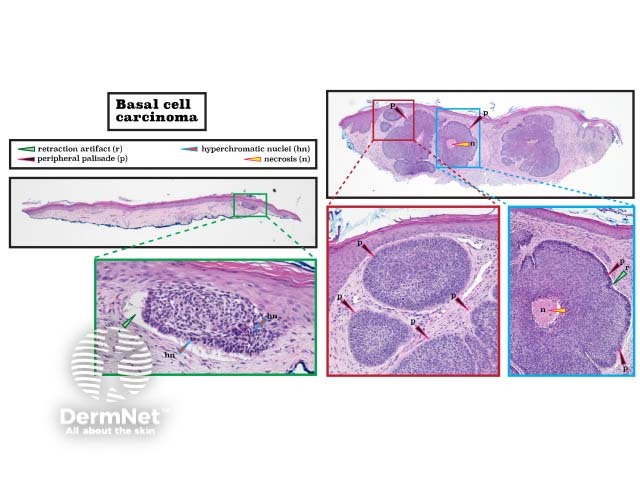 Histopathology of basal cell carcinoma