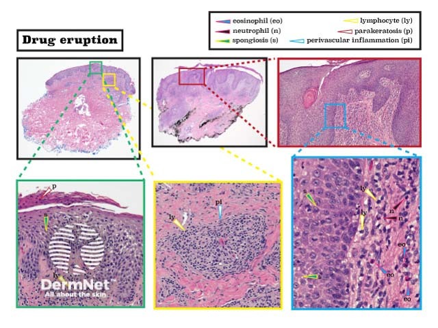 Histopathology of drug eruption