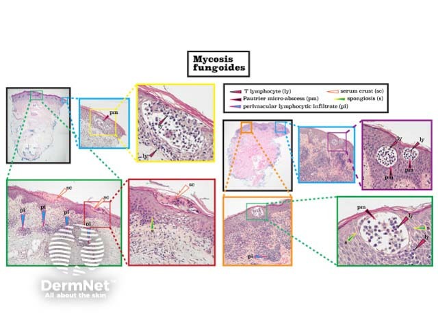 Histopathology of mycosis fungoides