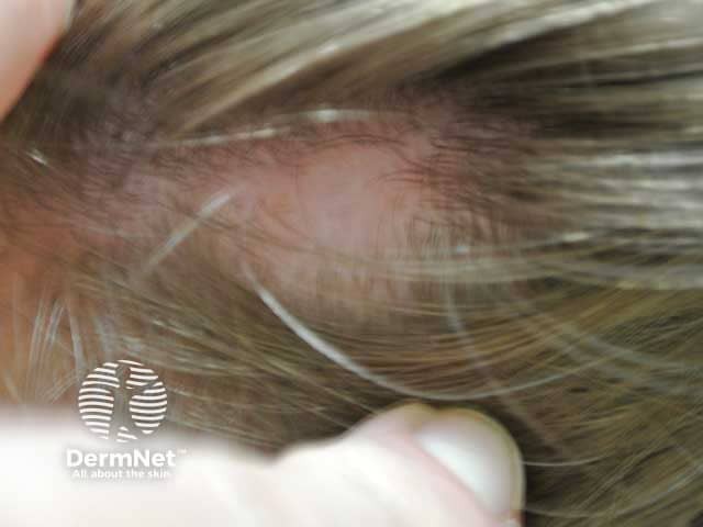 Patchy alopecia areata in a child