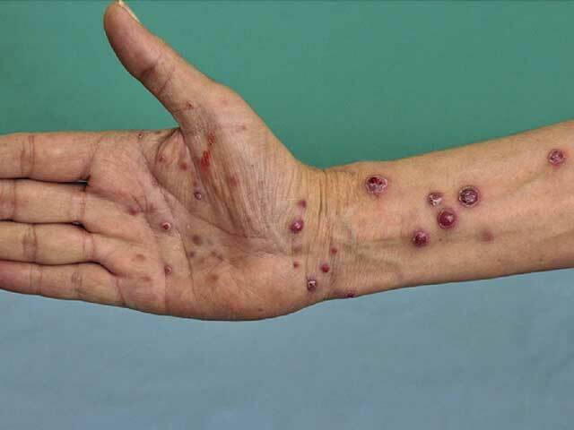 Bacillary angiomatosis in a transplant recipient