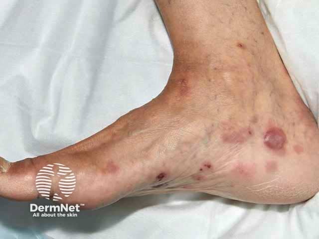 Blisters of bullous pemphigoid on foot, skin of colour