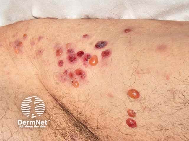 Bullous pemphigoid