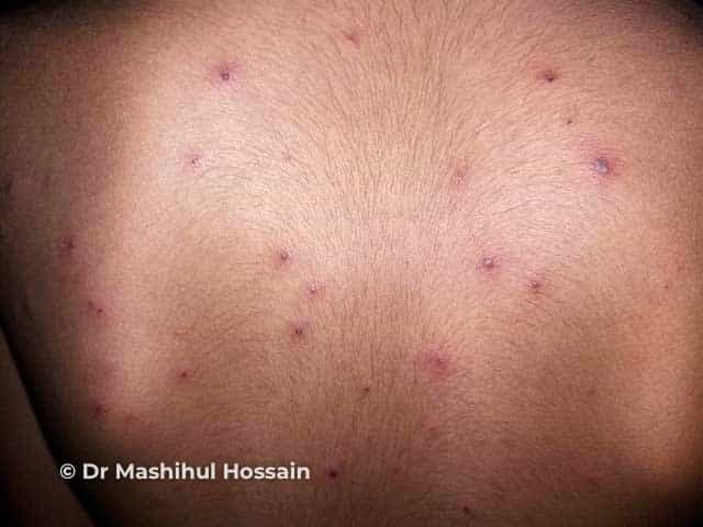 Chickenpox on back