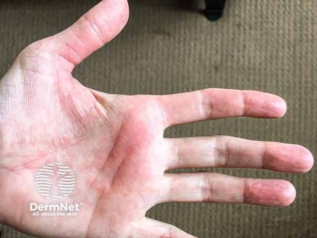 Palmar erythema