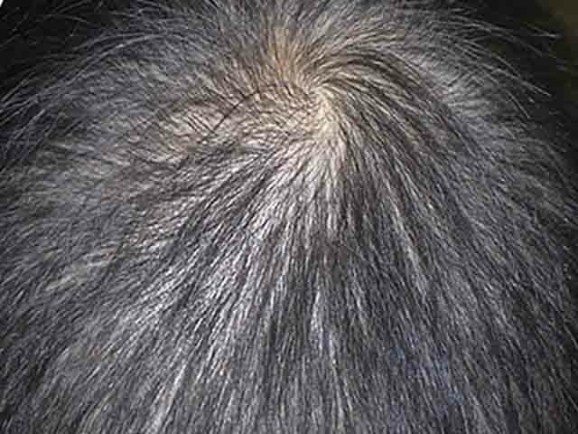 Diffuse alopecia