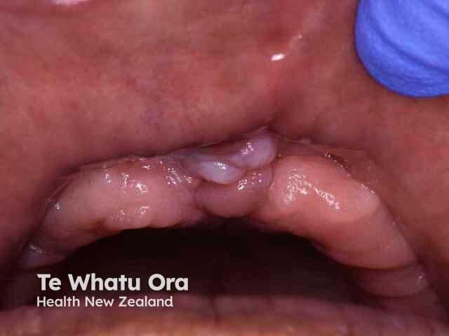 Oral irritated fibroma, maxillary labial frenulum