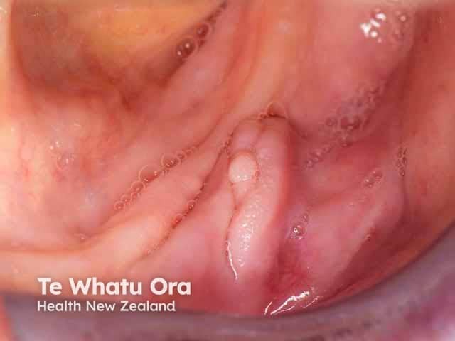 Epulis fissuratum, anterior mandibular buccal sulcus