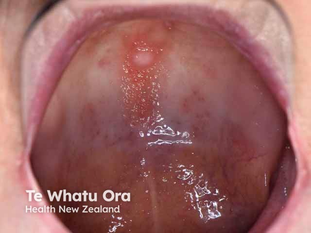 Oral irritated fibroma, hard palate