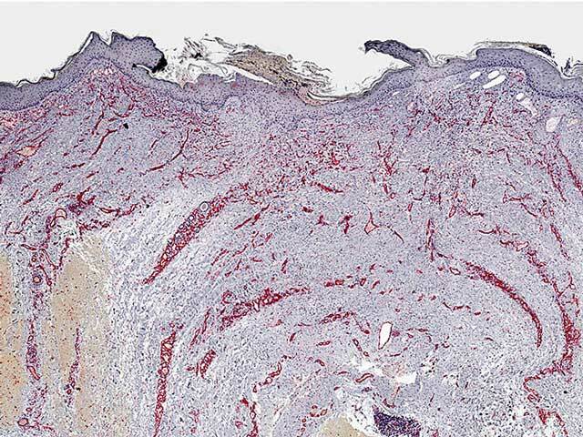 CD31 immunohistochemistry highlights blood vessels