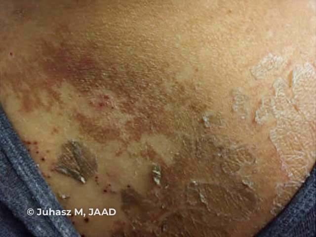 Kwashiorkor: peeling paint dermatosis