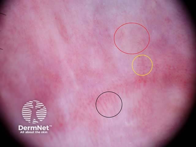 Vessels circled: hairpin (black), short linear and branching (red), dotted (yellow)