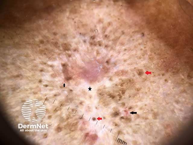 White area (black star), follicular plugs (red arrows), telangiectasia (black arrows)