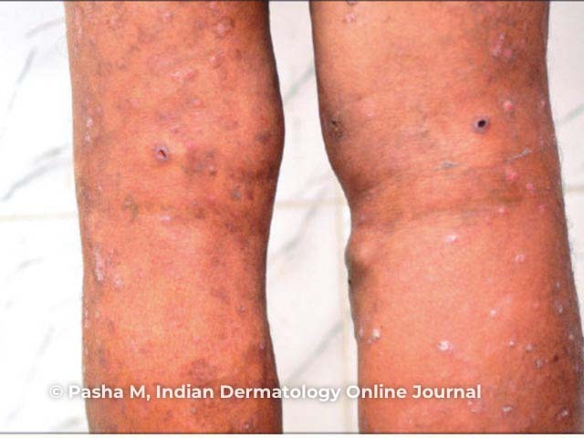 Onchodermatitis and limb oedema