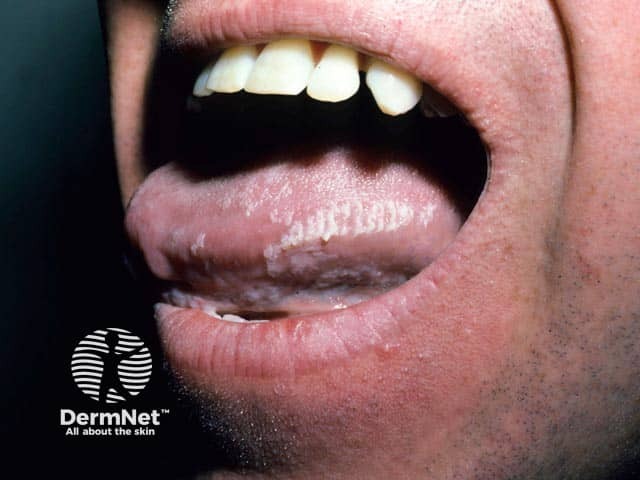 Oral hairy leukoplakia