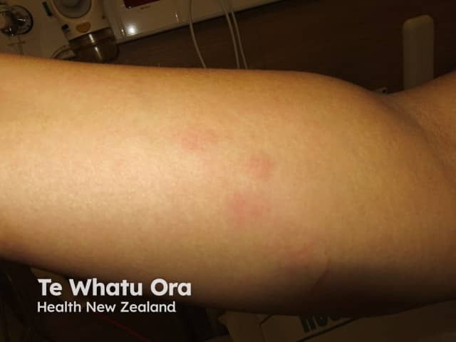 Urticaria in skin of colour